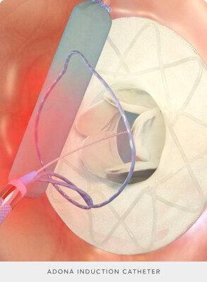 The Adona Medical interatrial shunt features a flow channel with an adaptable geometry that can be made larger or smaller post-implantation via the use of a proprietary induction catheter.