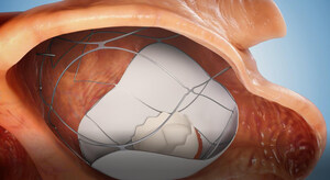 A New Era in Heart Surgery - Israeli Biomed Company TruLeaf Medical's Two Needle Sticks Procedure for Mitral Valve Replacement