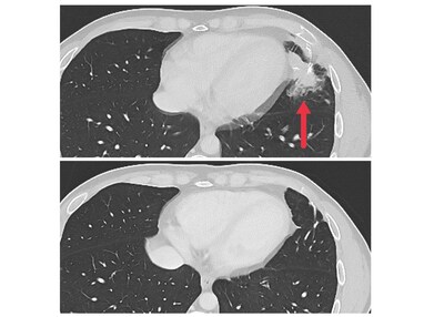 Image: Cross-sectional CT images showing a metastatic tumor in the left lung of a patient (top image) and no tumor following treatment (bottom image).   Credit: National Cancer Institute