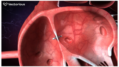 First U.S. Patient Implanted with the V-LAP Left Atrial Pressure Sensor by Vectorious Medical Technologies: A New Treatment Paradigm for Heart Failure Patients