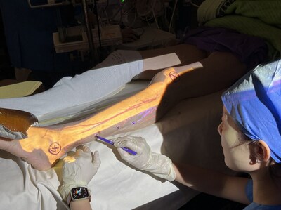Dr. Pu marks the perforator vessels for the fibula flap based on the projected 3D reconstructions of bones and vessels. The perforator vessels are visualized in purple.