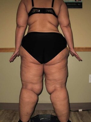 Type 3 Stage 3 Lipedema. Notice the disproportionate size of the buttucks, hips, thighs, and calves compared to the smaller waist. Note the lobules on the lateral thighs, knees, and upper arms.
