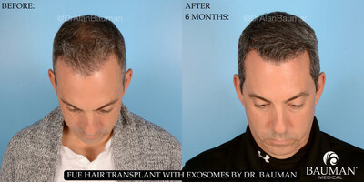 Before and 6 months after FUE Hair Transplant with Exosomes by Dr. Alan Bauman