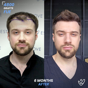 EsteNove Offers Exclusive Hair Transplant Packages for US Travelers During National Hair Loss Awareness Month