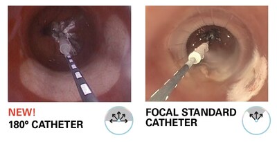 180° C2 CryoBalloon™ Catheter for Barrett’s Esophagus