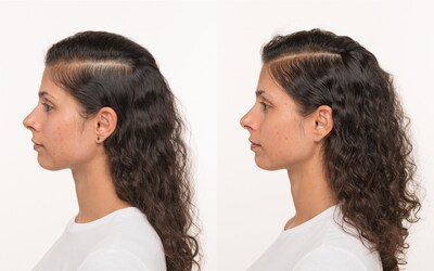 NULASTIN® | Left photo: before treatment. Right photo: after using NULASTIN® HAIR Vibrant Scalp Treatment for 12 weeks.