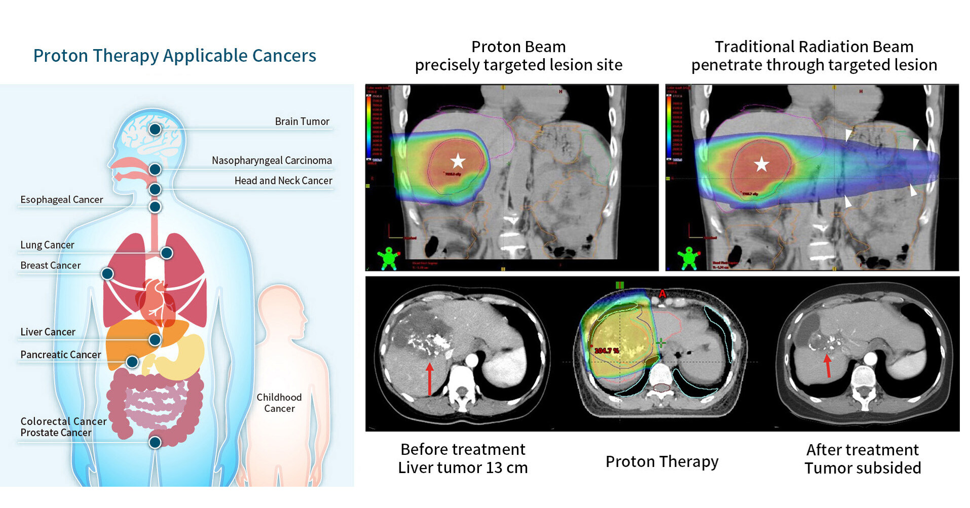 Chang Gung Cancer Proton Therapy Achieves Breakthrough