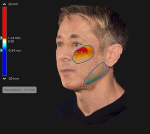 EMFACEの非侵襲的なフェイス・リフト効果の持続性に専門家は同意