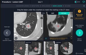 Body Vision Medical's Latest LungVision® Software Enhances AI Tomography, Improves Virtual Bronchoscopy and Introduces Revised Planning Interface