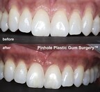 Patient "Dinah" Gums before and after Pinhole Plastic Gum Surgery™