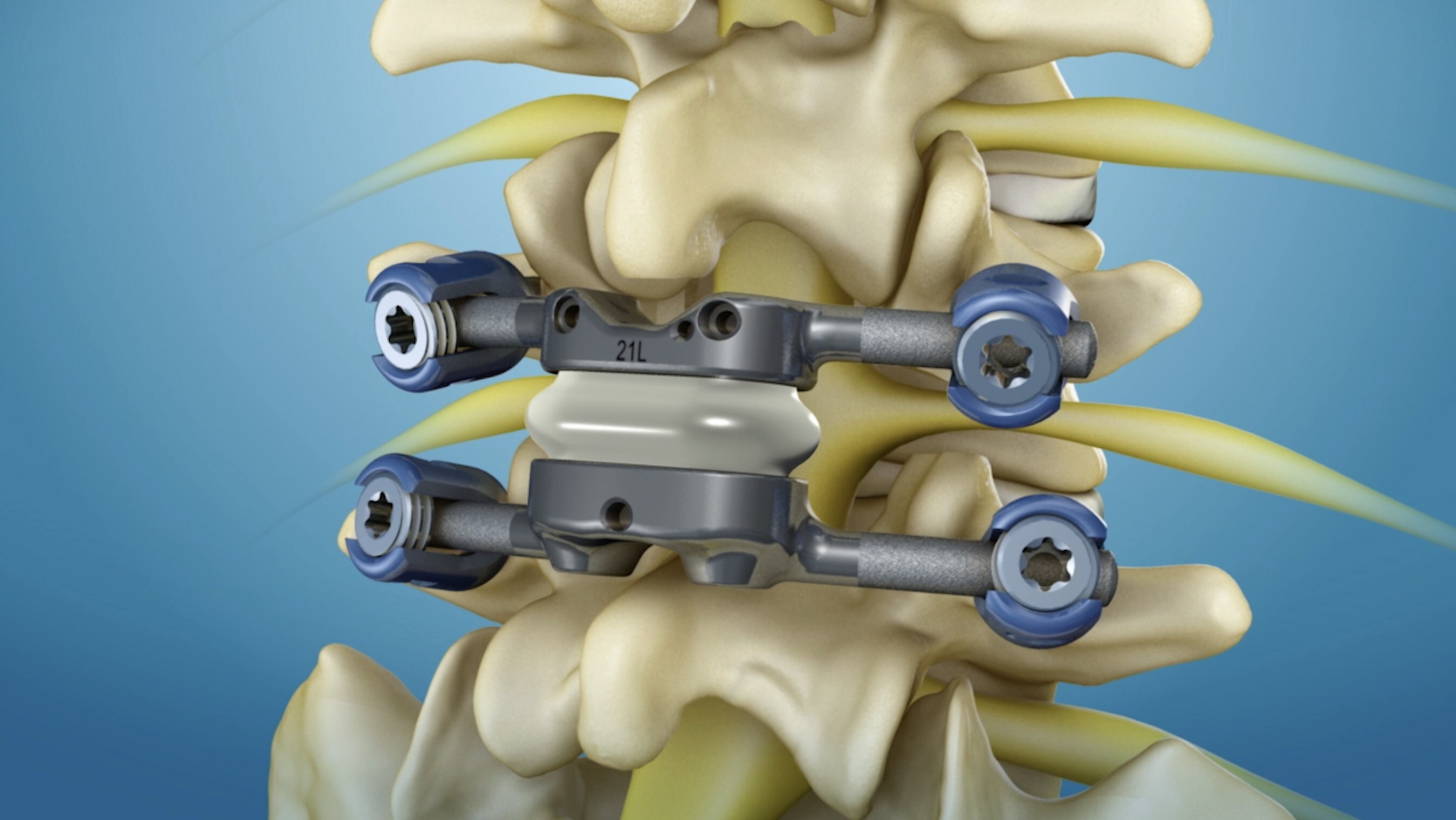 Premia Spine Wins Best Paper Award at SMISS 2024 for Study on Lumbar Facet Arthroplasty and the TOPS™ System