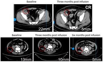 75% of patients experiencing a sustained reduction in tumor burden and diminished metabolic activity, and several lesions achieving complete response (CR) with 100% tumor reduction.