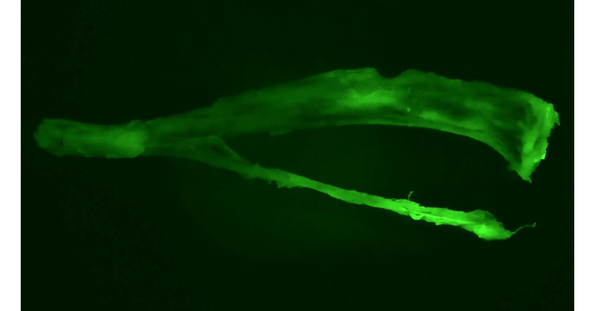 How does cancer spread? Follow the map