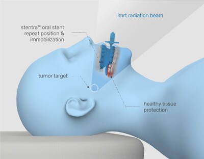 Stentra infographic