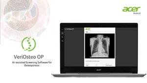 Acer Medical: VeriOsteo OP Raih Izin Produk Alat Kesehatan dari Kementerian Kesehatan Indonesia