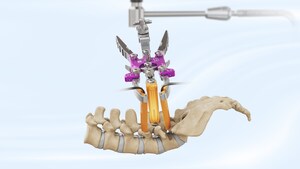 TeDan Surgical Innovations Launches Phantom ML3™ MIS Lumbar Surgical Access System, Offering Simplicity Without Compromising Versatility in Minimally Invasive TLIF Procedures