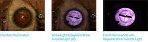 Beyeonics One Revolutionizes Ophthalmic Surgery with Invisible Light Technology