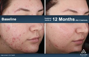 Accure Acne Announces New FDA Clearance for the Long-Term Treatment of Acne