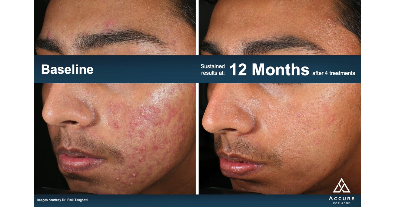 View of Accure Acne Announces New FDA Clearance for the Long-Term Treatment of Acne