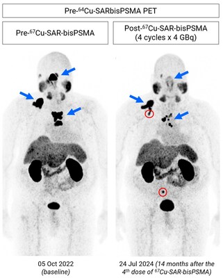 Images_show_considerable_reduction_lesion_uptake__64Cu_SAR_bisPSMA_PET__4_doses.jpg