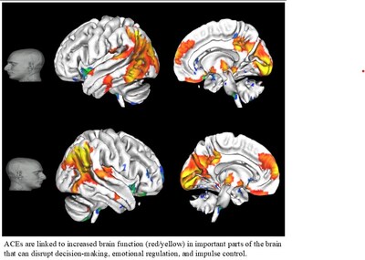 A groundbreaking study from Amen Clinics has revealed the powerful impact of adverse childhood experiences (ACEs) on brain function, offering critical insights into how early trauma shapes mental health in adulthood. Published today in Frontiers in Psychiatry, this is the largest brain-imaging study ever conducted on ACEs.