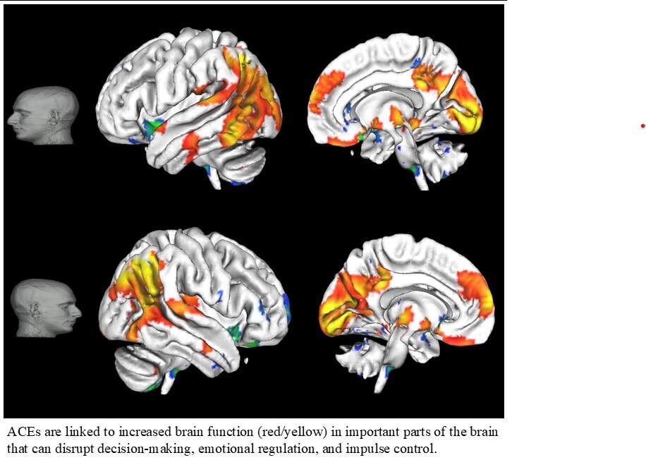 New Study Exposes Hidden Impact of Childhood Trauma on the Brain--Revolutionizing Mental Health Care