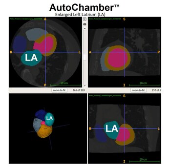 AutoChamber showing enlarged LA (left atrium)