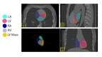 AutoChamber segmentation of cardiac chambers in a non-contrast cardiac scan