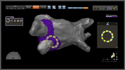 The VARIPULSE™ Platform is fully integrated with the CARTO™ 3 mapping system, which provides lesion indexing and electrode-tissue contact indication for electrophysiologists performing catheter ablation procedures.