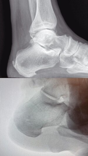 NEWPORT NEWS FOOT & ANKLE SURGEON PERFORMS FIRST MINIMALLY INVASIVE HAGLUND'S REPAIR ON THE PENINSULA