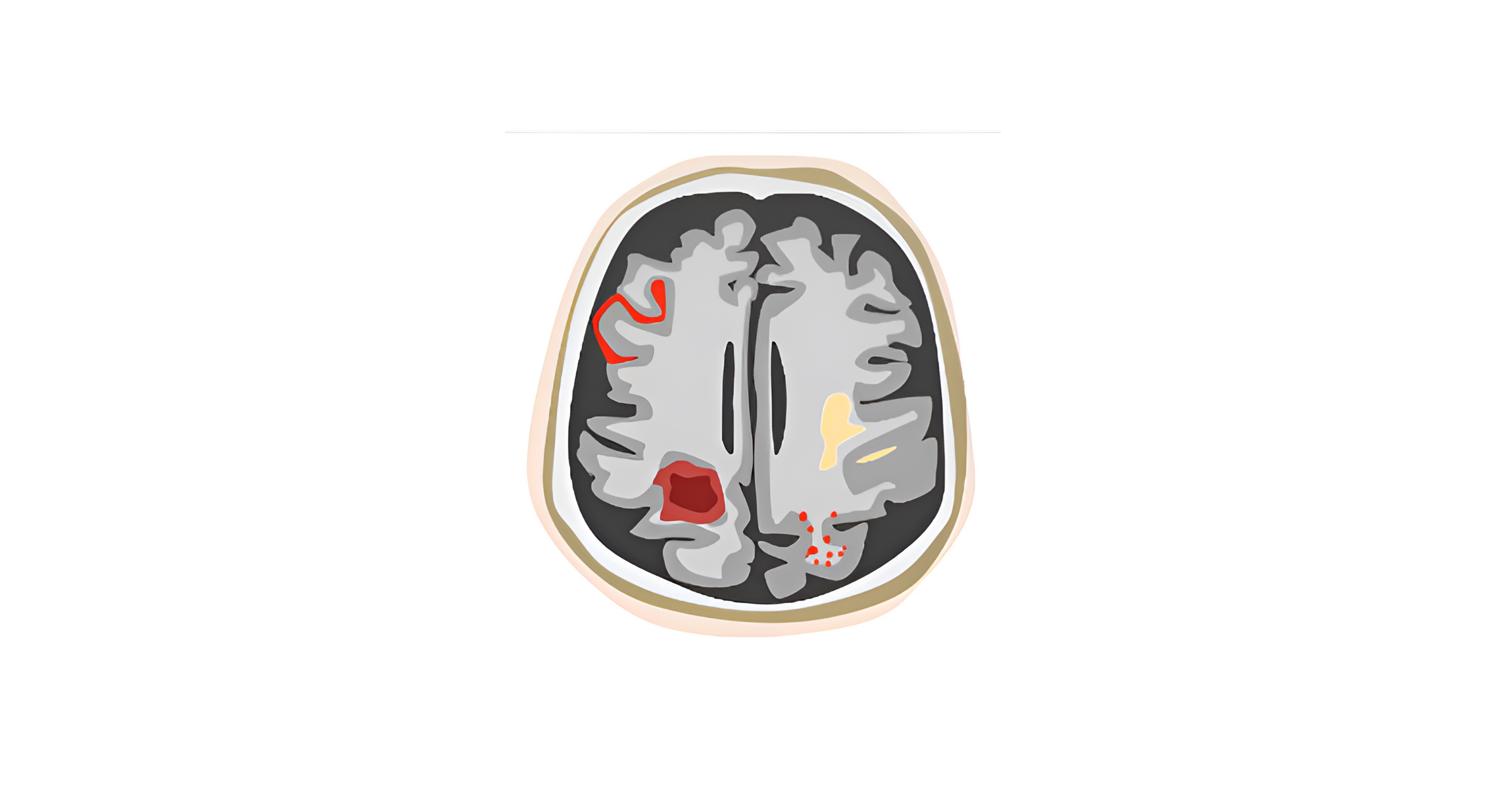 FDA authorizes the first AI-driven MRI solution for safer Alzheimer's treatment