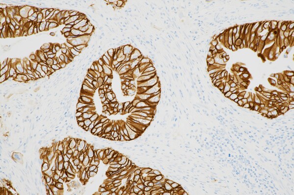 PATHWAY HER2 (4B5) assay for biliary tract cancer