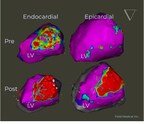 Field Medical's FieldForce™ Ablation System Earns FDA TAP Pilot Acceptance and Breakthrough Device Designation for the Treatment of Ventricular Tachycardia.