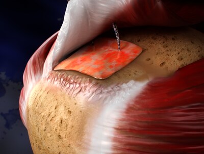 ROTIUM Bioresorbable Wick - Rotator Cuff Repair Augmentation