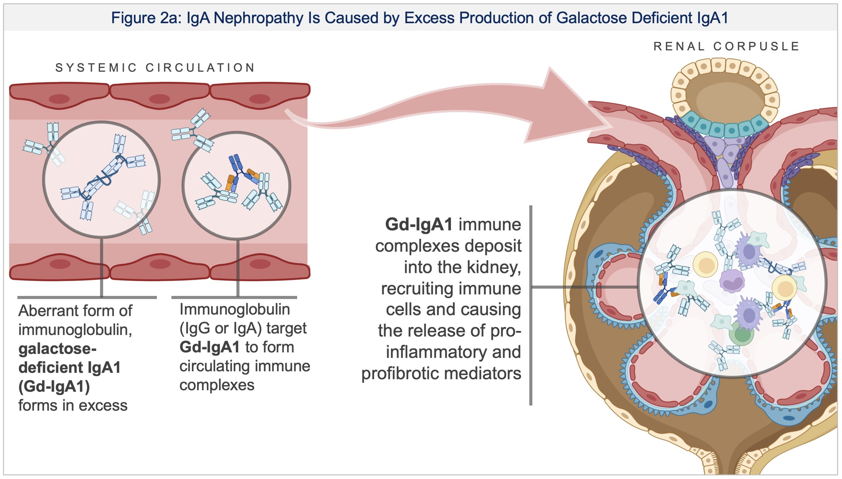 Figure 2: (A) IgA nephropathy is caused by excess production of galactose deficient IgA1 and deposition in the renal glomerulus, setting off an inflammatory cascade and renal damage.