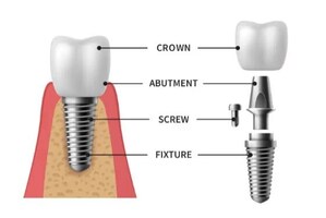 Pure Dental Health Elevates Full-Arch Dental Solutions with All-on-X, Zygomatic, and Pterygoid Implants