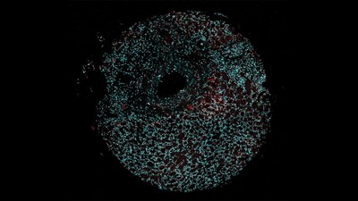 CSHL Assistant Professor Katherine Alexander and colleagues at the University of Pennsylvania have identified two different patterns of cellular structures known as nuclear speckles (red) in the most common form of renal cancer. They’ve also spotted a possible connection between these patterns and patient survival rates. Their work is published in Nature Cell Biology.