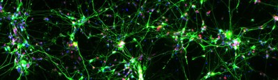 Autologous iPSC-derived neurons