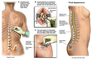 San Raffaele Hospital (Milan, Italy): new, promising results from the first patients implanted with the spinal neurostimulator. A new, high-frequency spinal stimulation protocol gives hope for motor recovery and reduced muscular spasticity