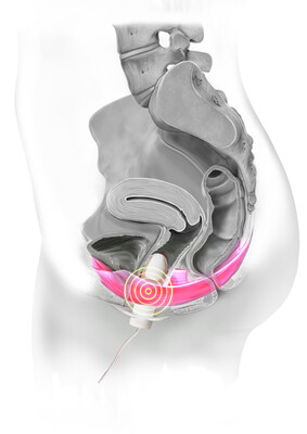 Flyte Mechanotherapy