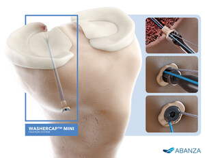 ABANZA Receives FDA 510(k) Clearance for WasherCap™ Mini Implantable Fixation Device