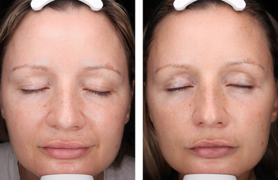VISIA imagery of a patient before starting regimen (left) and after 30 days of RoC 35 protocol use (right). VISIA imagery of a patient before starting regimen (left) and after 30 days of RoC 35 protocol use (right).