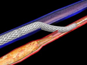 St. Luke's First in Region to Provide Novel Treatment for Avoiding Lower-Extremity Amputations