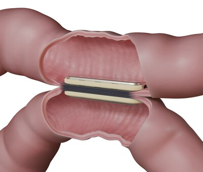 The MagDI System is a self-aligning, incisionless, sutureless, and staple-free technology designed to facilitate anastomosis while leaving behind no foreign material.1-5