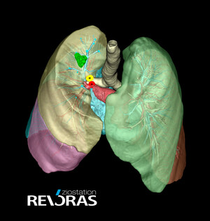 Olympus Announces Launch of AI-Powered Surgical Planning Tool Through Strategic Partnership with Ziosoft