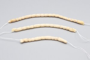 ALLOSOURCE® ANNOUNCES 200TH IMPLANT OF ACECONNEX® PRE-SUTURED FASCIA DEVICE FOR HIP LABRAL RECONSTRUCTION AND AUGMENTATION