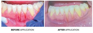 Introducing Young® ClearDefense™ Silver Fluoride - a Breakthrough in Sensitivity Protection from Young® Specialties