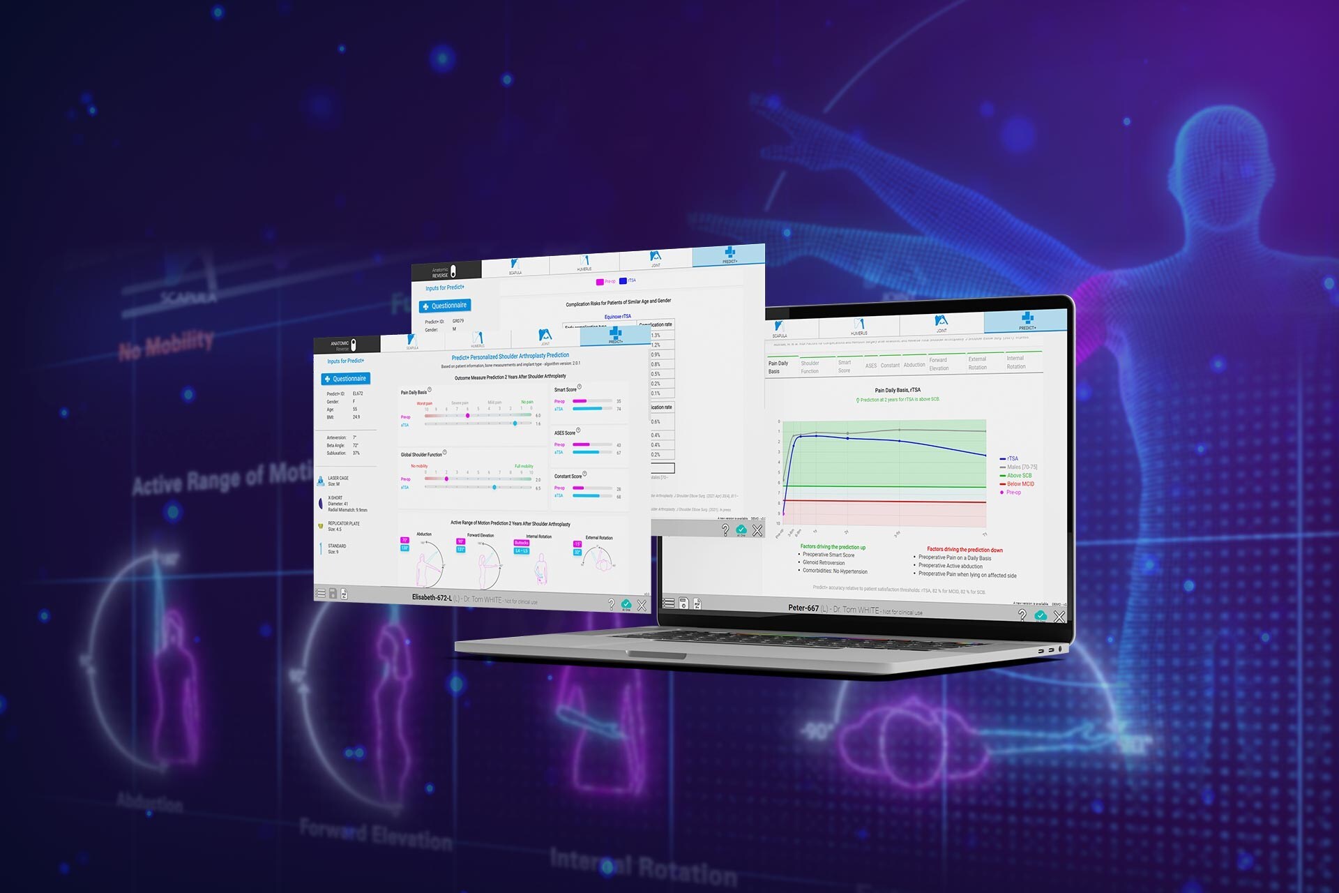 Exactech Unveils Next Generation of Predict+®, the First Machine Learning Tool for Predictive Outcomes in Shoulder Replacement Surgery