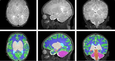 Antenatal opioid exposure is associated with smaller neonatal brain volumes, with varying impact depending on the type and number of exposures, according to research published in JAMA Pediatrics. Stephanie Merhar, MD, MS, at Cincinnati Children's was first co-author.