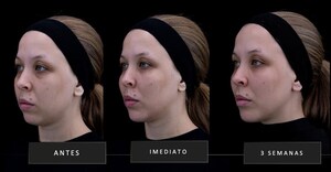 Galderma apresenta Restylane® ShaypeTM, a próxima geração de ácido hialurônico injetável